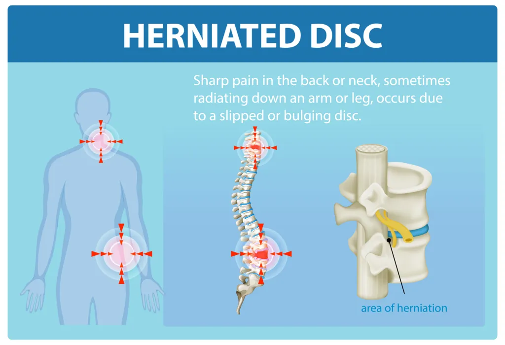 Chiropractor in McAllen, TX - Herniated & Bulging Discs